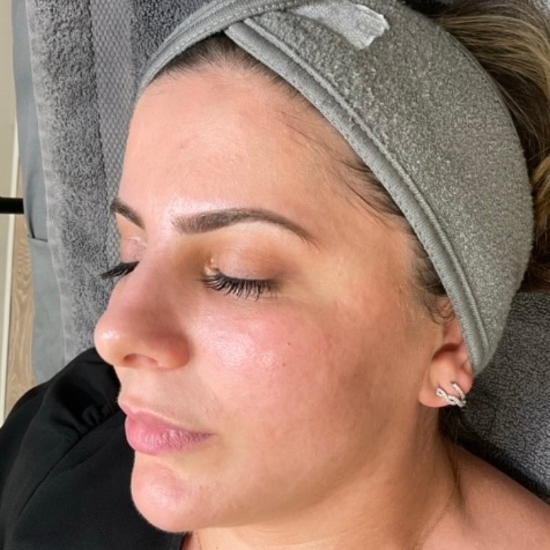 Sciton BBL Before & After Image