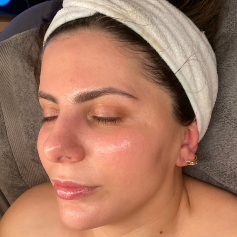 Sciton BBL Before & After Image