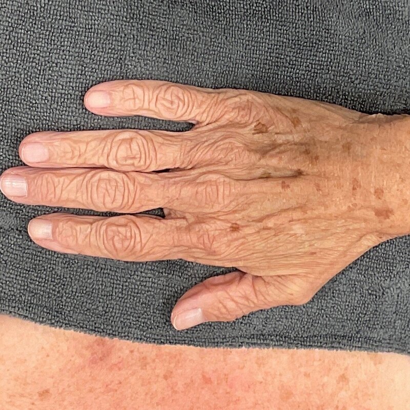 Sciton BBL Before & After Image