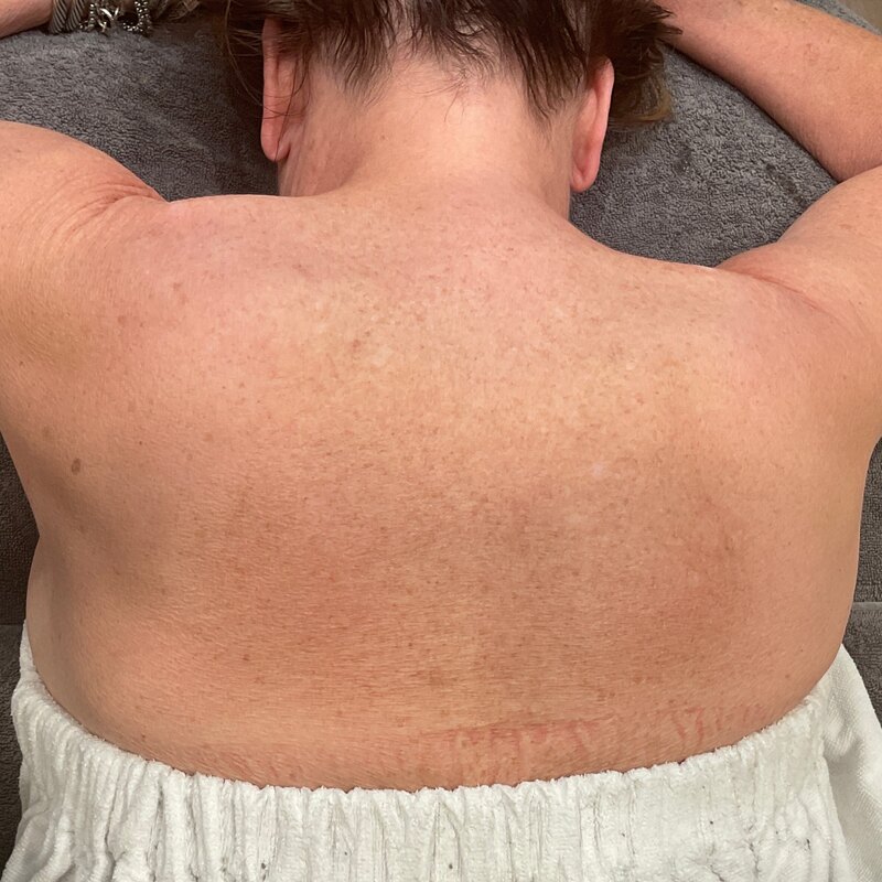 Sciton BBL Before & After Image