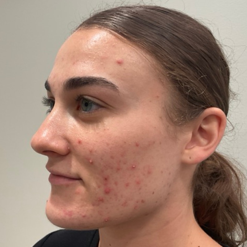 Sciton BBL Before & After Image