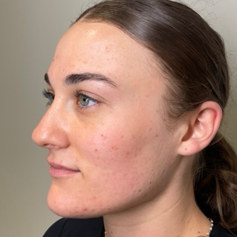 Sciton BBL Before & After Image