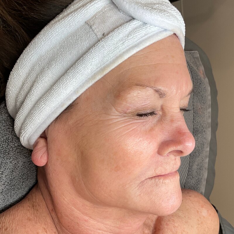 Sciton BBL Before & After Image