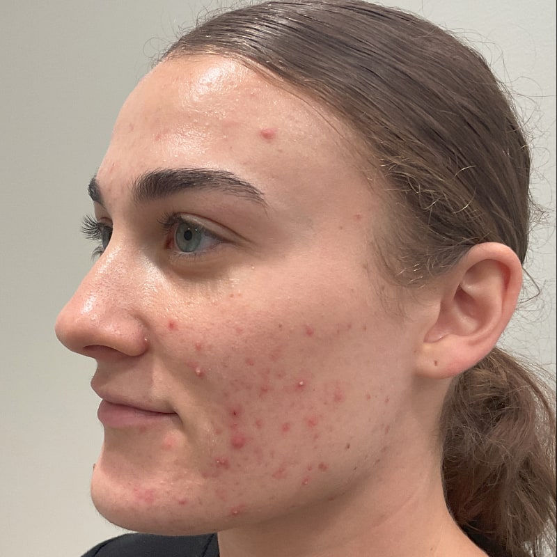 Sciton Forever Clear Before & After Image