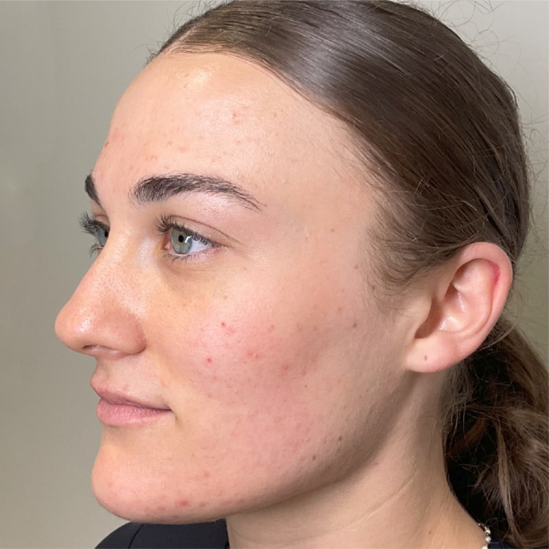 Sciton Forever Clear Before & After Image